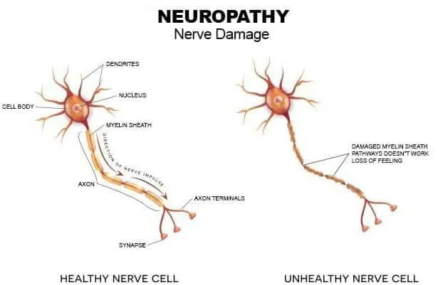 Nerve support illustration